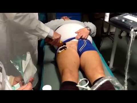 Dolore addominale con osteocondrosi Ernia L4-L5-S1