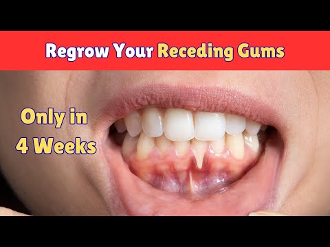 Regrow Your Gums: Receding Gums Care | Medical Miracle