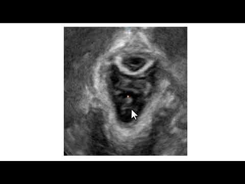 Ultrassonografia do assoalho pélvico na avaliação do sling retropúbico