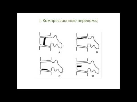 Стреляющие боли в спине и ногах Артроз коленного сустава 2 степени что это