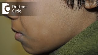 How to cure white patches on face in a young individual? - Dr. Rasya Dixit