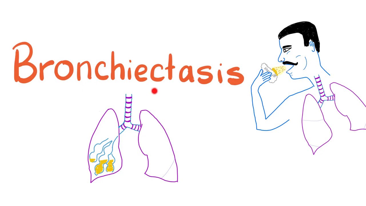Bronchiectasis - YouTube