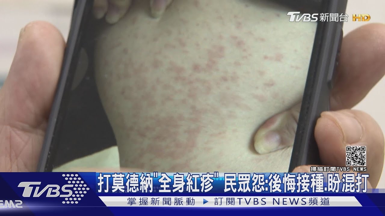 接種莫德納後全身「佈滿紅疹」四天未消 民眾哀號:盼混打