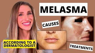 Best Melasma Treatment? Dermatologist Explains Melasma: Causes, At Home Treatments, & More