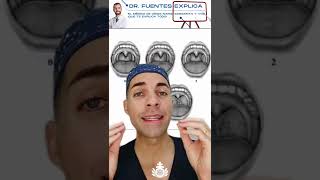 Otorrinolaringología: Las amígdalas