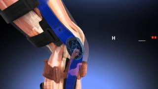 Product video: Breg Axiom-D Elite Knee Braces