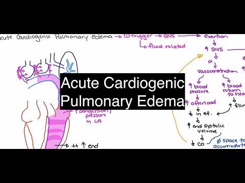 Acute Cardiogenic Pulmonary Edema