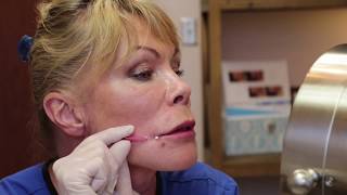 Demonstration of Threads Used to Enhance Lip Borders & Lift Mouth Corners