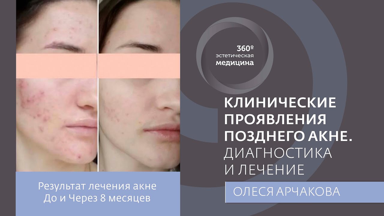 Клинические проявления позднего акне. Диагностика и лечение