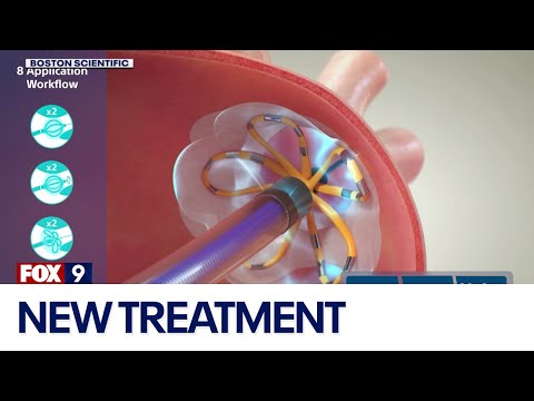 Mayo Clinic offering new atrial fibrillation treatment