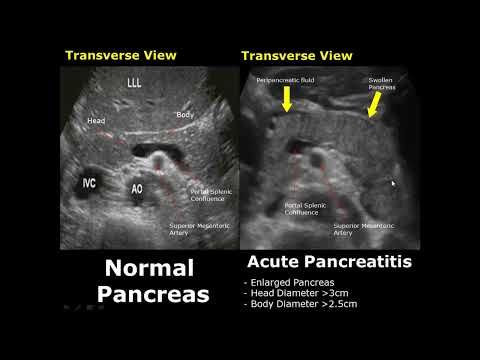 Vergleich normaler und pathologischer Ultraschallbefunde der Bauchspeicheldrüse | Pankreaspatholo...