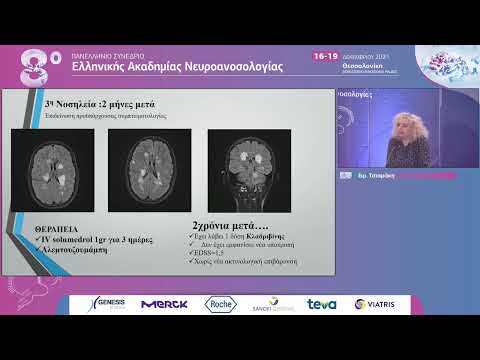 Τσιαμάκη Ε. - Προβληματισμοί στη μακροχρόνια θεραπευτική προσέγγιση της κεραυνοβόλου σκλήρυνσης κατά πλάκας