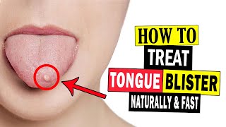 How to Get Rid of Tongue Blisters Naturally at Home || Home Remedies for Tongue Blisters