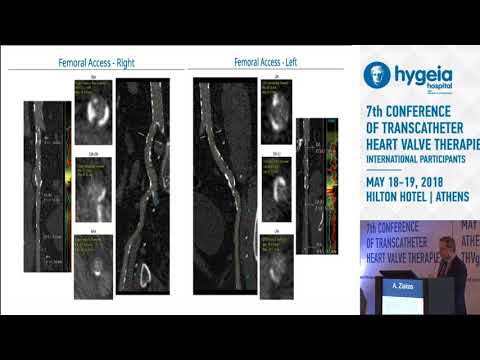 A.Ziakas  | My best and worst TAVR case of the year. The single most important lesson learned