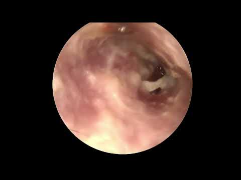 Treatment of Fungus in ear - Dr. Akanksha Jain 