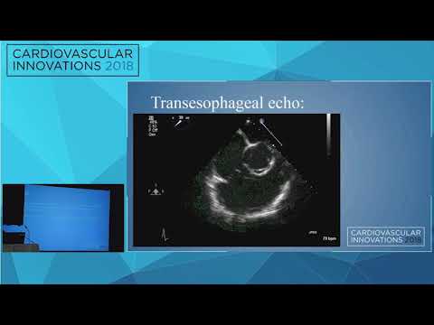 CVI2018 Session: Atrial Septal Endocarditis Complicating Tricuspid Valve Endocarditis