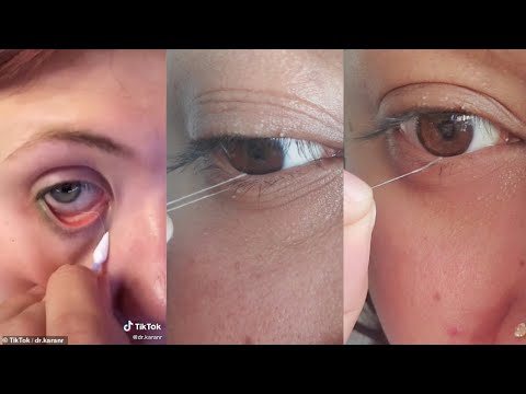 Super Satisfying EyE String And Eye Booger Removal | TiKTok Compilation