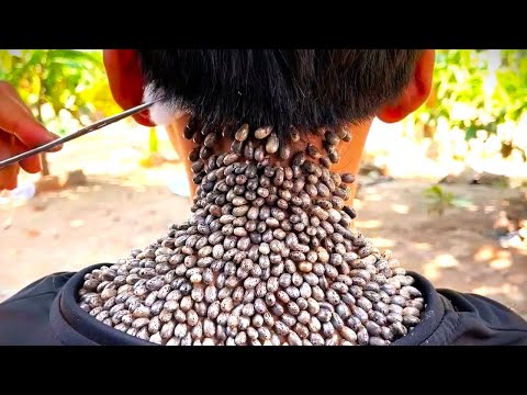 ¡No vas a creer cómo estas GARRAPATAS casi DEVORAN vivo a este chico! ️