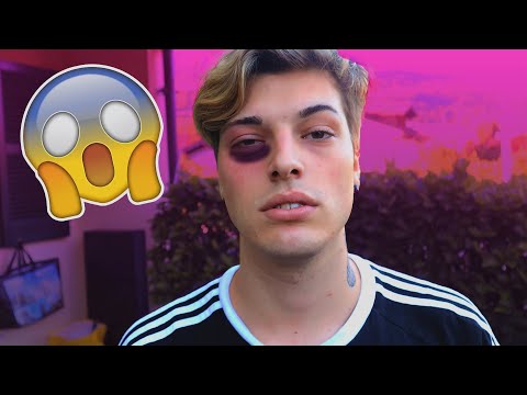 HO quasi PERSO UN OCCHIO durante un video *DOLOROSO*