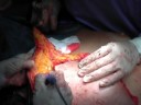 Skin sparing mastectomy, ricostruzione mammaria, TRAM flap, plastic reconstructive surgery professor mario dini www.chirurgia-plastica-estetica.it