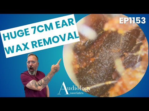 One Of Our Biggest Ear Wax Removals! - EP1153