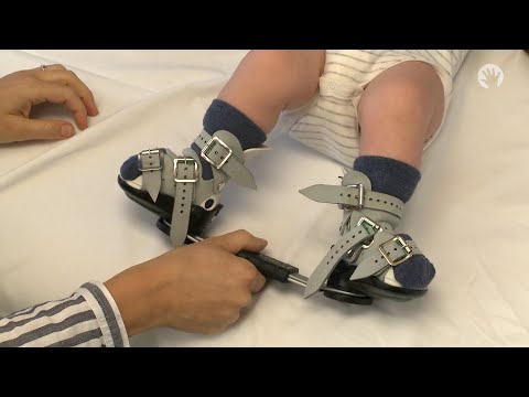Clubfoot Stretches | Ponseti Brace | Module 4