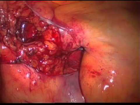 Laparoscopic Sigmoid Colectomy or Colon Resection