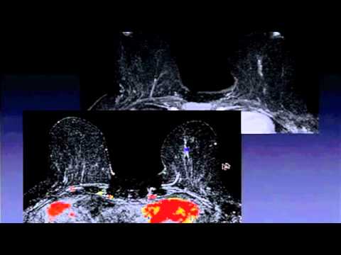 PRACTICAL BREAST MRI preview clip: Newstead on MRI of DCIS