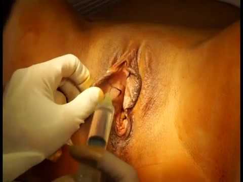 Labiaplasty surgery (labia minora reduction) by Dr. Daniel A. Medalie  of Cleveland Plastic Surgery 