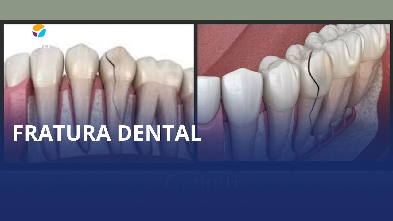 🦷 Fratura dental em pauta