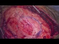 Right Convexity Craniotomy For Resection of Symptomatic Atypical Meningioma