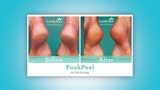 patchology PoshPeel Pedicure