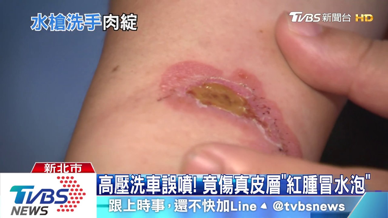 高壓洗車誤噴! 竟傷真皮層「紅腫冒水泡」