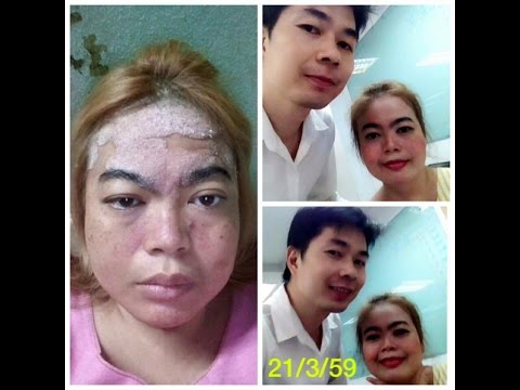 ครีมสำหรับกลากและ neurodermatitis กลากแห้งในมนุษย์