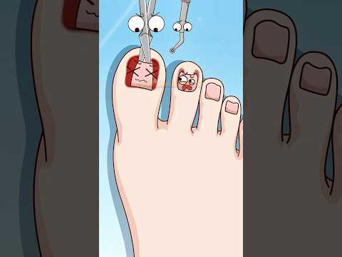 🦶Por que ocorre a paroníquia?❓#shorts