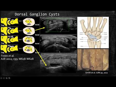 image-What does an ultrasound of the wrist show?