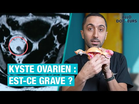Kyste ovarien : est-ce grave ? Le Dr Jimmy Mohamed vous répond - Allo Docteurs