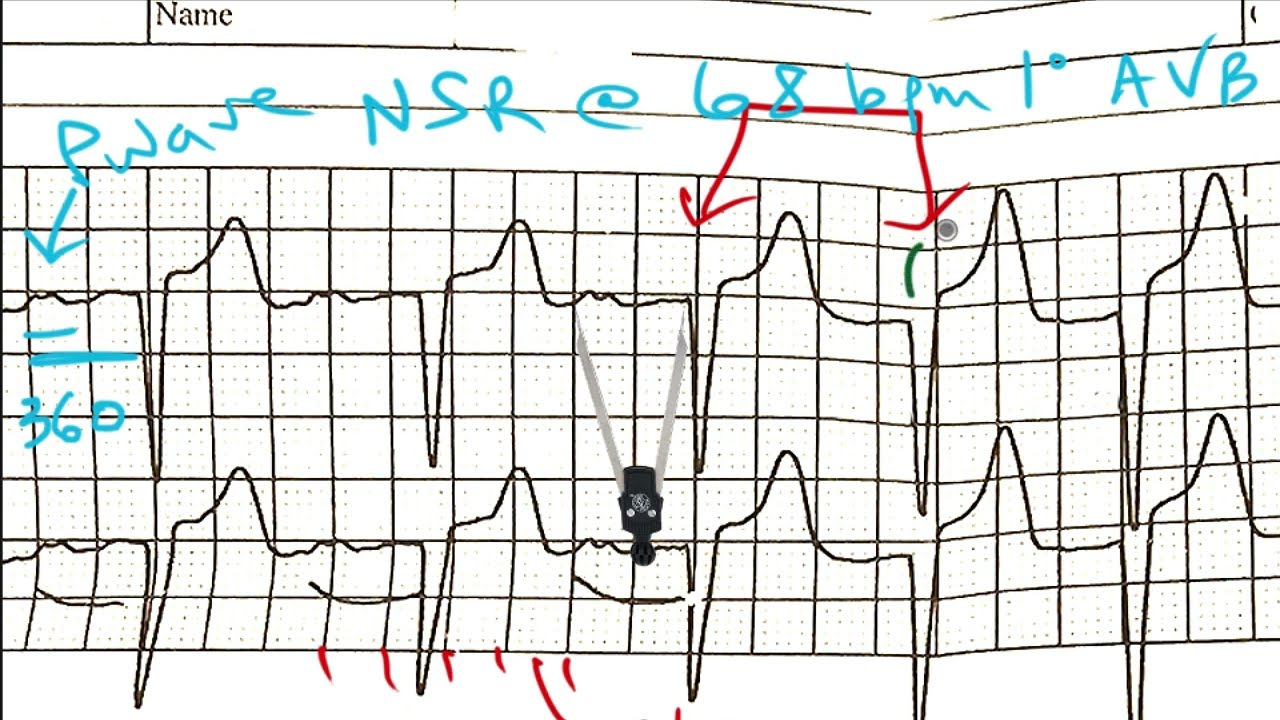 ECG Academy ChalkTalk #632 - Learn to Read Complex ECGs/EKGs and rhythm strips