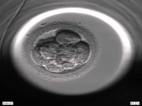 Mal di pietre bassa della schiena A forma di scoliosi con lato sinistro del torace colonna vertebrale 1 grado