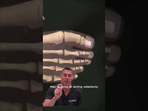 Why I Don\'t Recommend this Bunion Surgery "Silver Bunionectomy! "