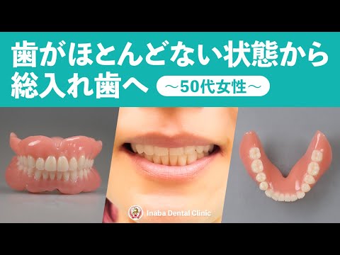歯がほとんどない状態から総入れ歯へ〜50代女性〜