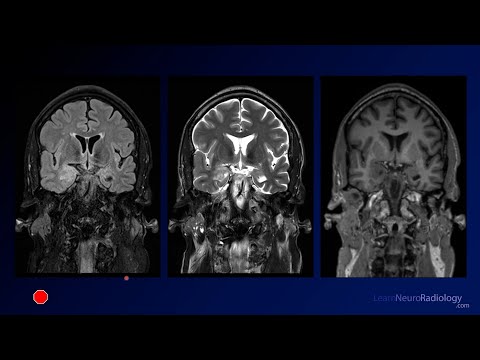 Neuroradiology Board Review - Brain Tumors - Case 13
