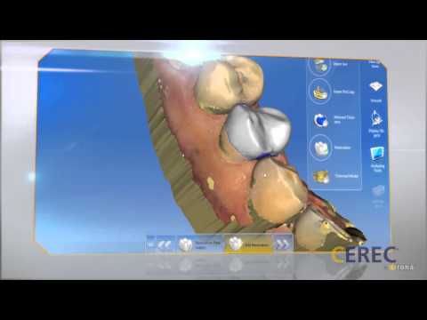 CEREC Cadcam System for All Ceramic Restorations in a Single Visit