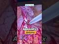 Appendix Ka Operation Kaise Hota Hai Appendicitis Treatment I Appendix Ka Ilaj I Appendix Bimari