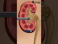 Kidney Stone Treatment PCNL Shorts
