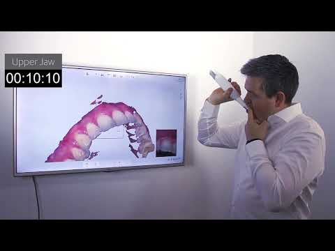 3Shape TRIOS 3 Wireless Insane Speed in Action