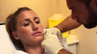 Aumento de Labios con Ácido Hialurónico en Clínica Estética Esbeltic Model de Madrid.