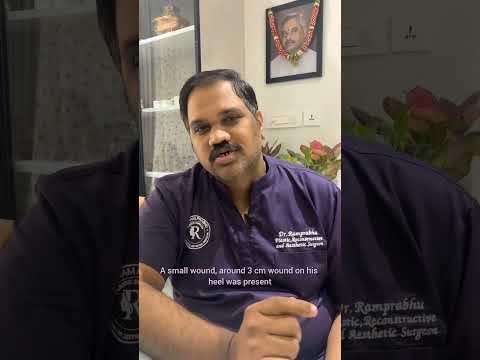 Hidden Achilles tear short video thumbnail by Dr. Ram Prabhu.