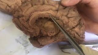 Dr Medhat - Brain “ medial surface “ 2