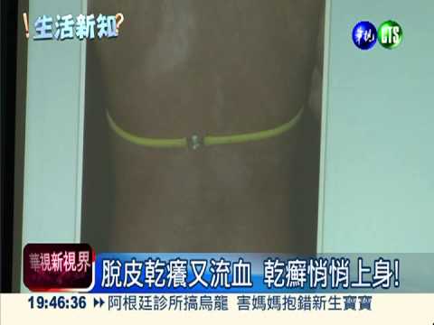 狂進補增加免疫力 乾癬更嚴重